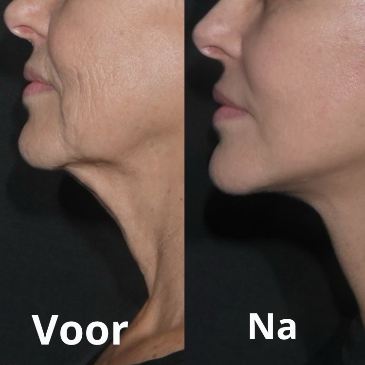 Verstevigt Gezicht & Nek Zonder Naalden en Zonder Chirurgie